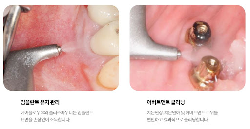 천안 임플란트 보장 정책
